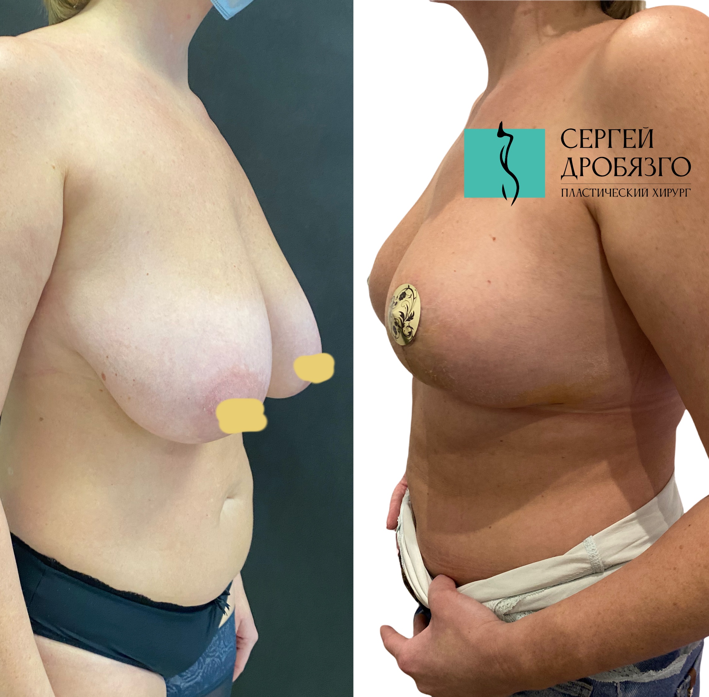 упражнение для подтяжки груди для женщин фото 105